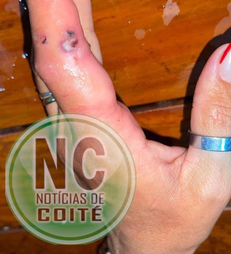 Mulher com dedo inchado busca Águia Resgate para retirar anel em Coité